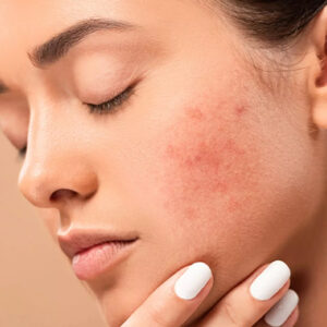 What Is a Spot? How Is Spot Treatment Done?