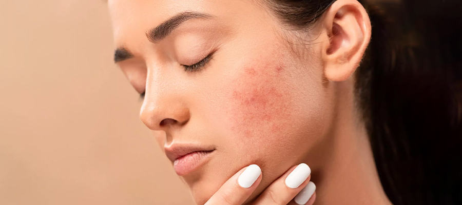 What Is a Spot? How Is Spot Treatment Done?