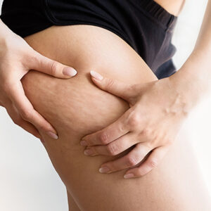 What is Cellulite Treatment? How to Get Rid of Cellulite?