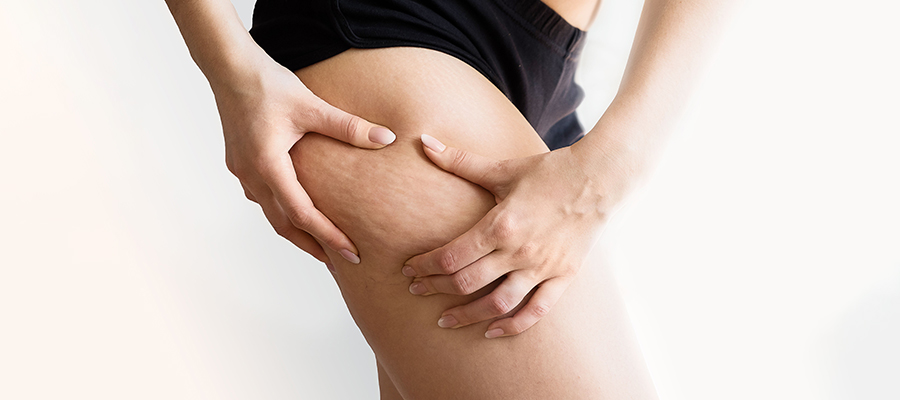 What is Cellulite Treatment? How to Get Rid of Cellulite?