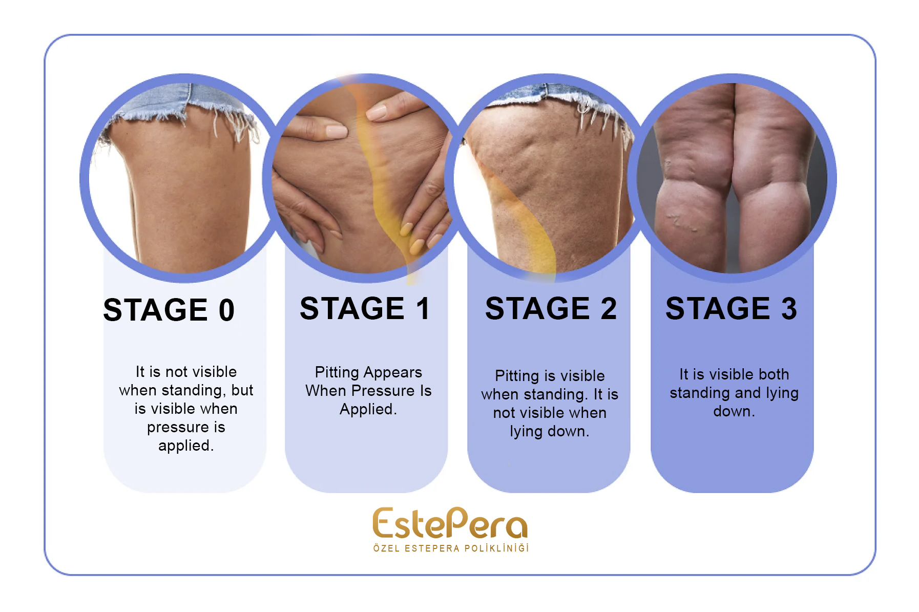 cellulite stages