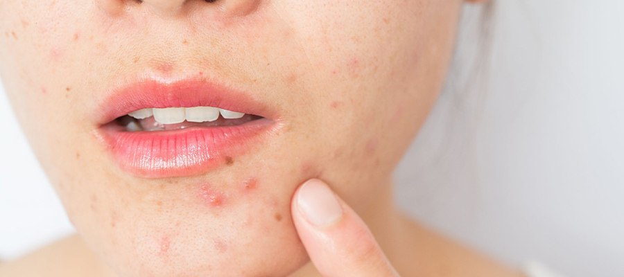 How to Get Rid of Acne Scars on the Face?