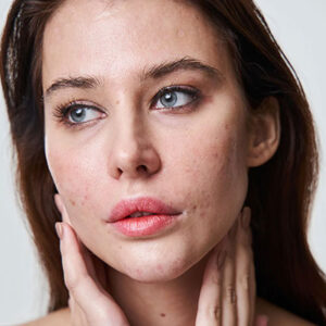 How to Get Rid of Blemishes on Your Face?