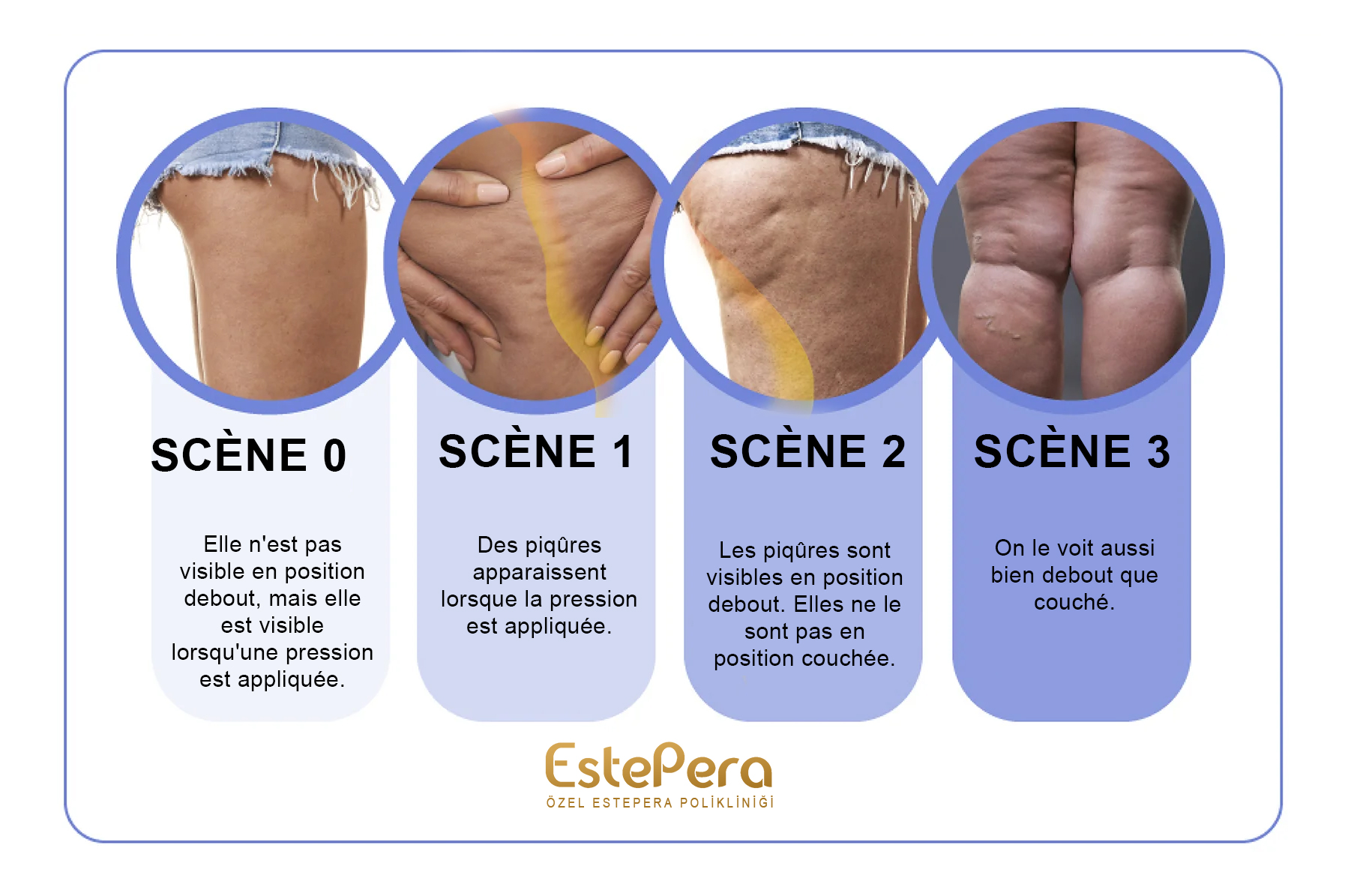 stades de la cellulite