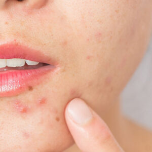 Comment Faire Disparaître les Taches d’Acné sur le Visage ?