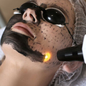 Peeling au Carbone