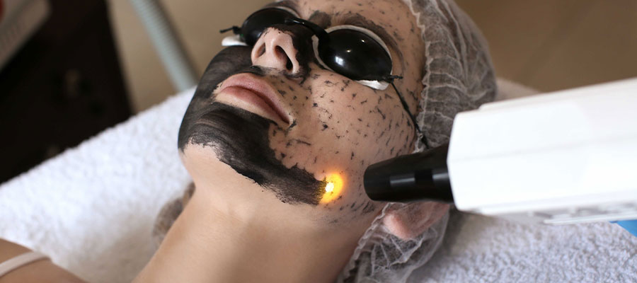 Peeling au Carbone