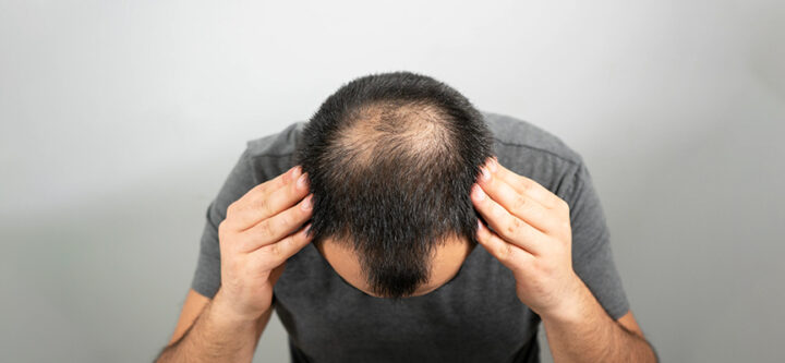 Diagnosis and Treatment of Androgenetic Alopecia Diagnosis and Treatment of Androgenetic Alopecia
