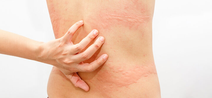 Herpes Zoster and Herpes Simplex Diagnosis and Treatment of Herpes Zoster and Herpes Simplex