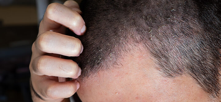 Diagnosis and Treatment of Seborrheic Eczema Diagnosis and Treatment of Seborrheic Eczema