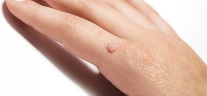 Verruca Treatment of Verruca Vulgaris and Callus