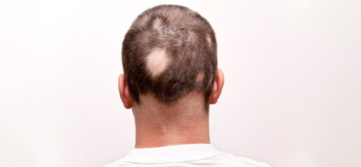 diagnostic-et-traitement-de-lalopecie-areata Diagnostic et Traitement de l'Alopécie Areata