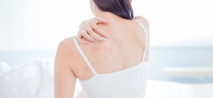 diagnostic-et-traitement-de-lurticaire Diagnostic et Traitement de l'Urticaire