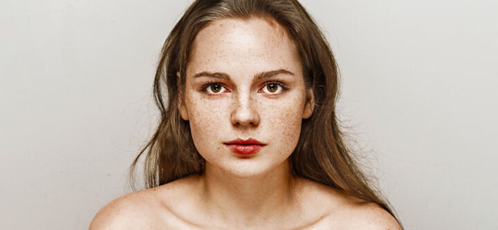 diagnostic-et-traitement-du-melasma Diagnostic et Traitement du Mélasma