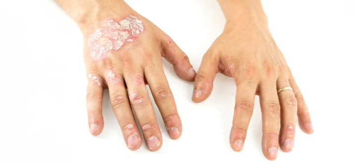 Diagnostic et Traitement du Psoriasis