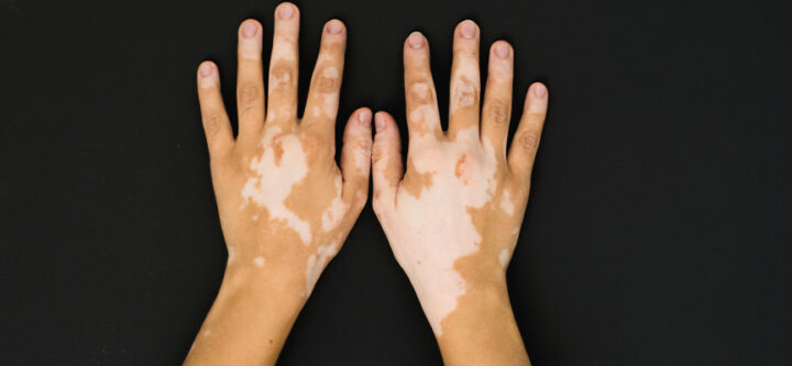 diagnostic-et-traitement-du-vitiligo Diagnostic et Traitement du Vitiligo