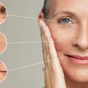 Kırışıklık Tedavisi