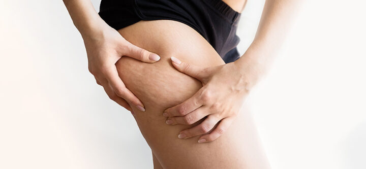 Qu'est-ce-que-le-traitement-de-la-cellulite-Comment-sen-débarrasser Qu'est-ce que le traitement de la cellulite ? Comment s'en débarrasser ?