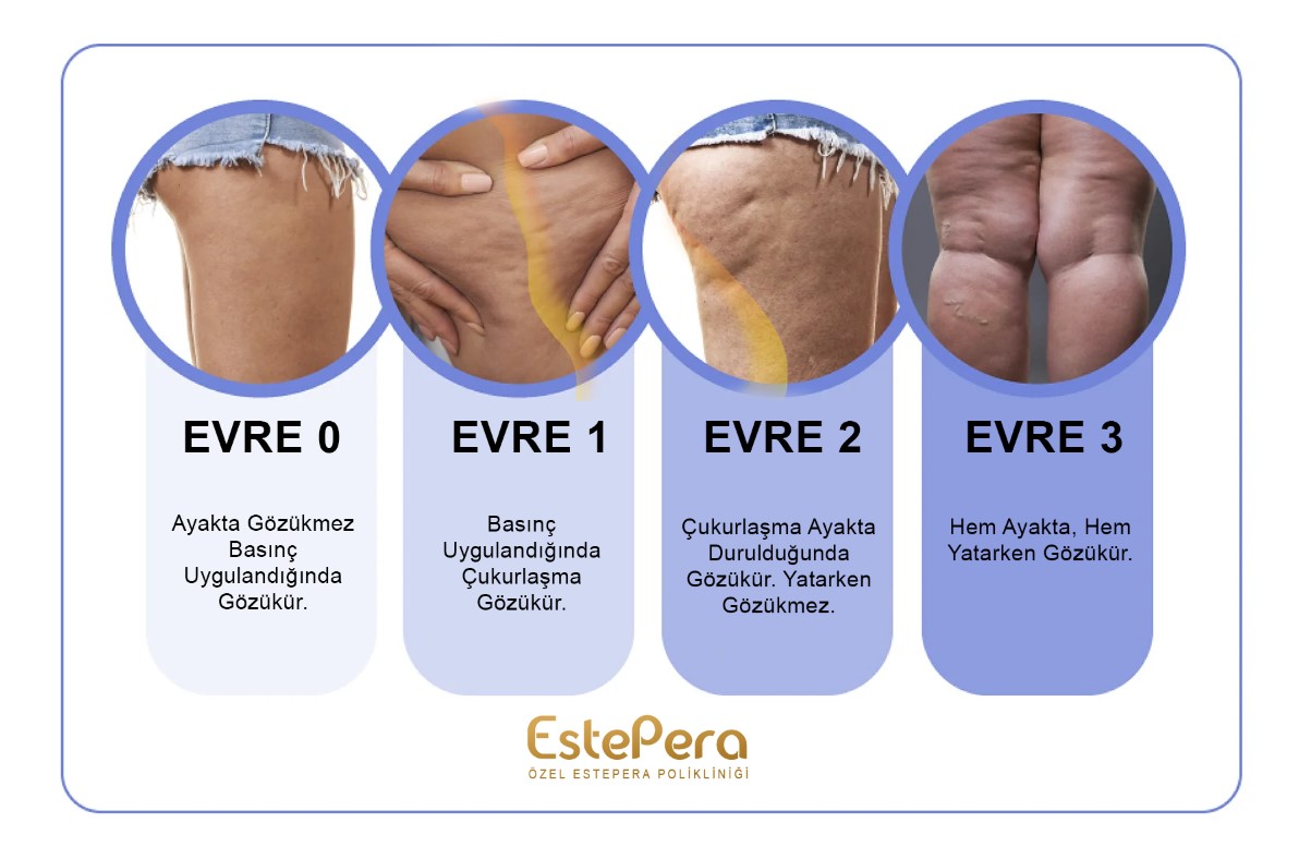 selulit evreleri