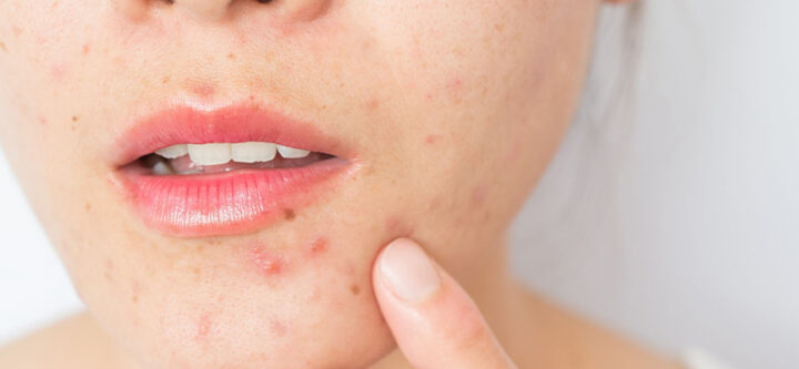 Comment-se-débarrasser-des-cicatrices-dacné-sur-le-visage Comment se débarrasser des cicatrices d’acné sur le visage
